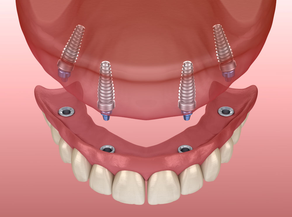 Santa Barbara All-on-4 dental implants